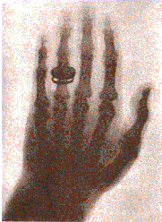 XRAY of hand.gif (23570 bytes)